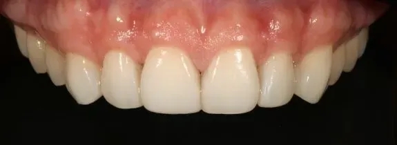 Composite Veneers