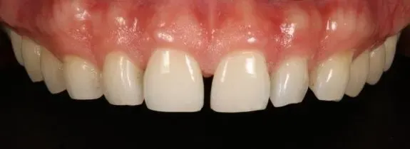 Composite Veneers