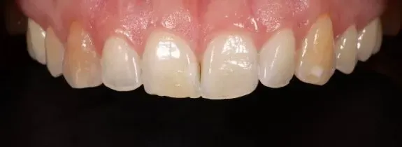 Whitening and Bonding